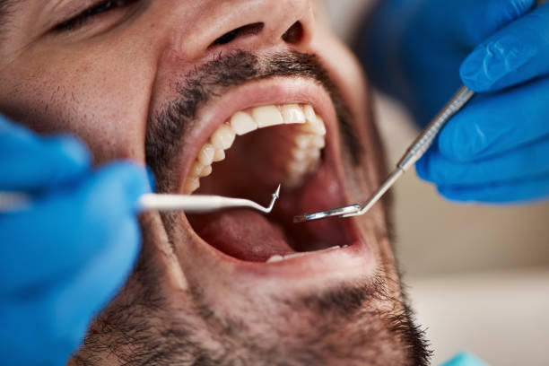 Best Emergency Tooth Extraction in Start, LA