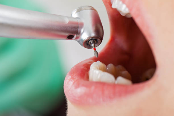 Best Emergency Tooth Extraction in Start, LA